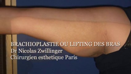 BRACHIOPLASTIE OU LIFTING DES BRAS-Large