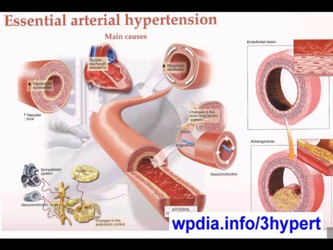 Hypertension - Hypertension Symptoms - Treating Hypertension