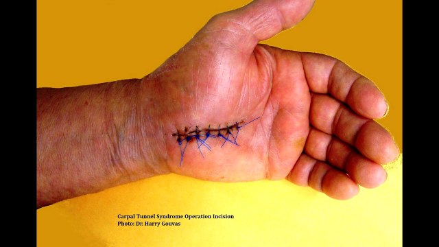 Carpal Tunnel Syndrome - Do You Need Surgery?