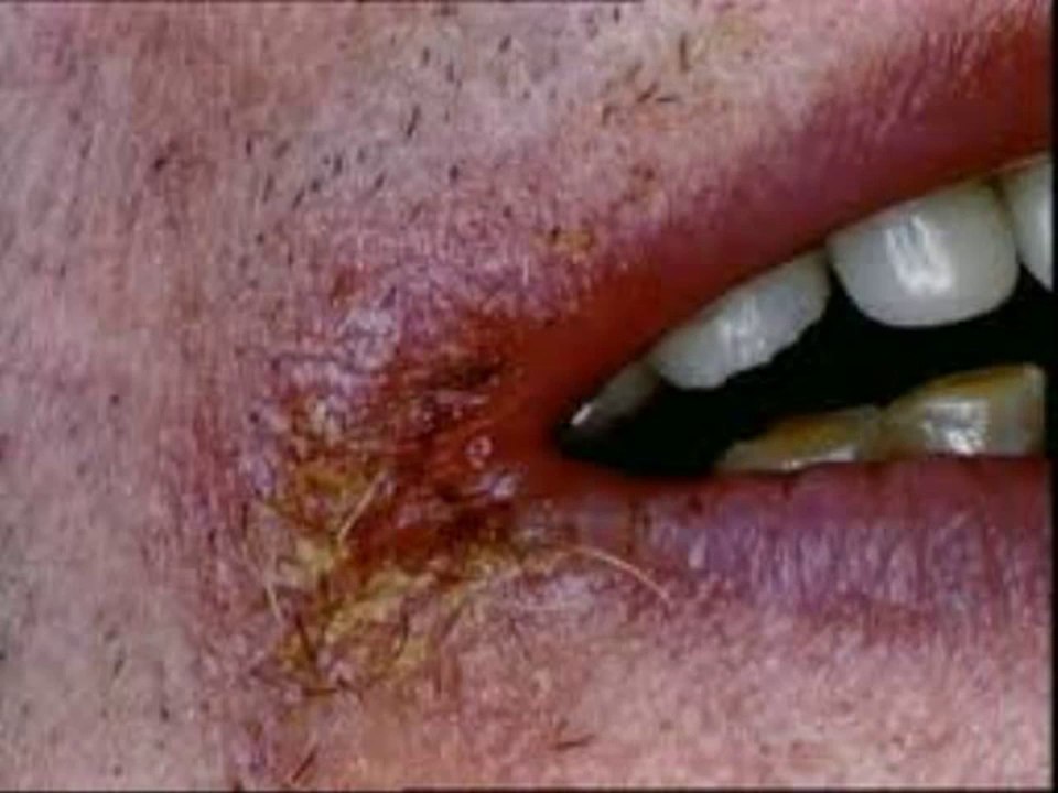 Queilitis angular : Tratamiento causas queilitis