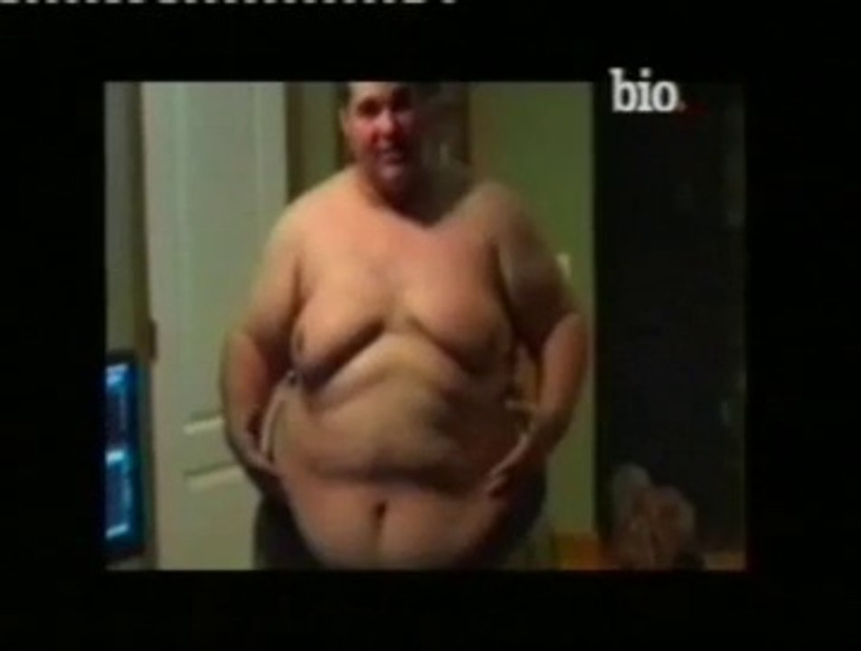 Obesidad morbida: Chad