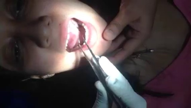 Laser Frenectomy Treatment in New Delhi , Ankyloglossia Treatment in Delhi Clinic, Laser Frenectomy Surgery Delhi