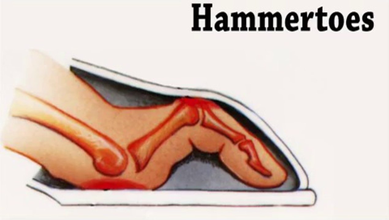 Hammertoes and Corns - Podiatrist in Elyria and North Ridgeville Ohio