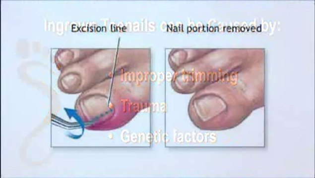 Ingrown Nails - Podiatrist in North Ridgeville, Elyria OH - George Costaras, DPM