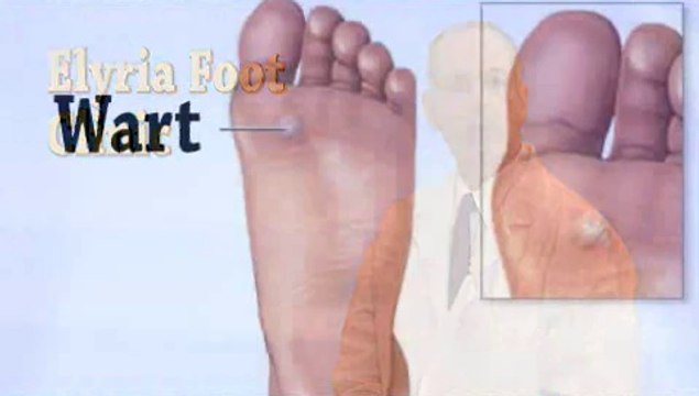 Foot Warts - Podiatrist in North Ridgeville, Elyria, OH - George Costaras, DPM
