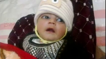 Burned baby arrives for treatment in Scotland from pakistan