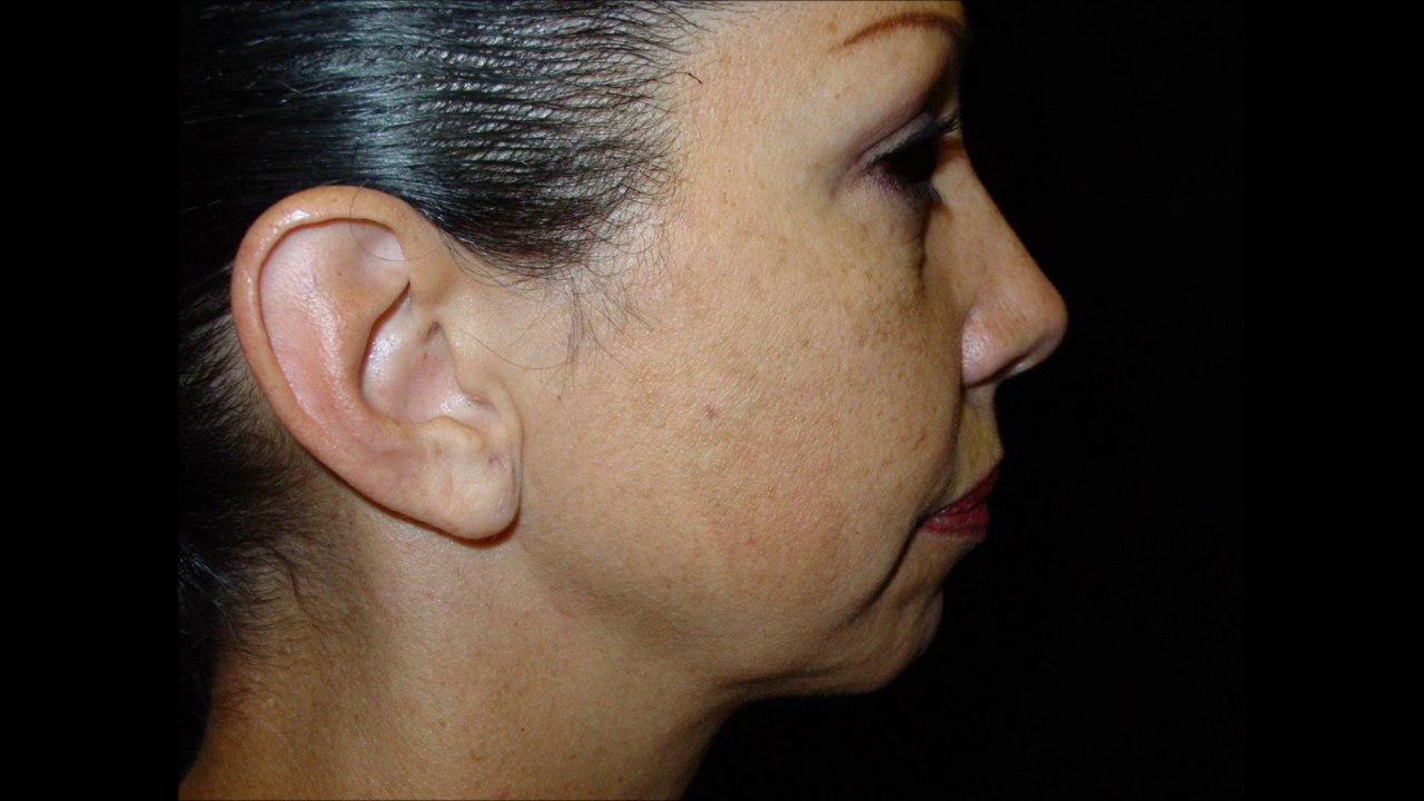 Orange County/Newport Beach Necklift Photos