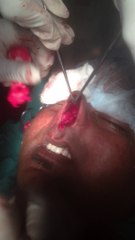 rhinoplasty for hump nose
