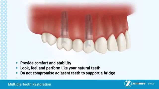 Dental Implant supported bridge sanford lady lake multiple tooth replacement tampa, mount dora, tooth removal