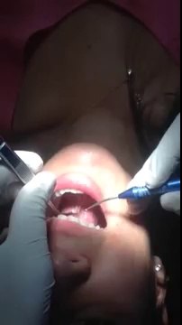 Laser Frenectomy Surgery Delhi, Cost of Frenectomy surgery in South Delhi, Periodontal Frenectomy Care in Safdarjung Enclave