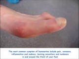 Causes, symptoms and treatment of Hammer toes