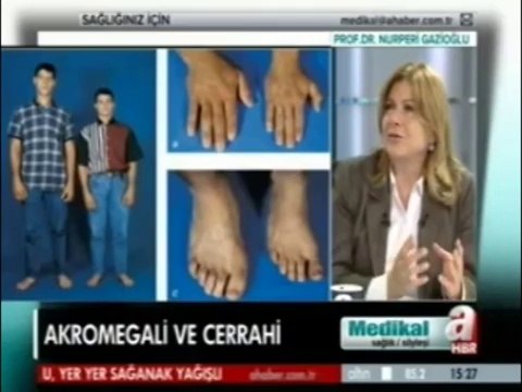 Prof. Dr. Nurperi Gazioğlu, akromegali hastalığı hakkında bilgiler veriyor part 2
