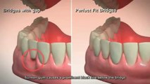 Wisdom tooth teeth extractions removal the villages, tavares, leesburg teeth removal socket preserva
