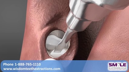 Wisdom Teeth Extractions orlando lady lake mount dora