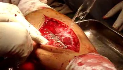 Imran Poly Trauma Operated By Professor Dr. Noor Akbar Sial Faisalabad 03009660588