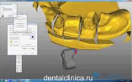 CAD моделирование в стоматологии, протезирование в Clinic of Aesthetic Dentistry