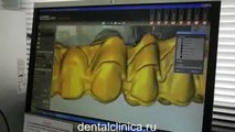 CAD модель, изготовление и протезирование зубов на имплантах European Clinic Dentistry