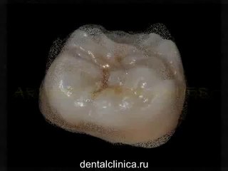 Dental CAD моделирование, металлокерамика коронка, инновационное протезирование