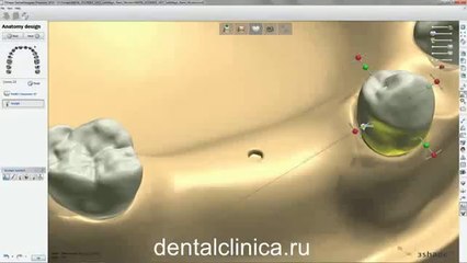 Hi-Tech Telescope Моделирование протезирование European Clinic of Aesthetic Dentistry