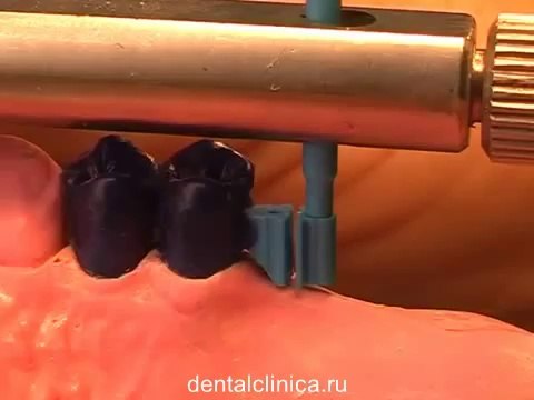 Клиника эстетической стоматологии, протезирование инновационные системы, урок видео обучение