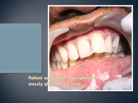 BCS DENTAL IMPLANT PLACEMENT IMMEDIATELY AFTER EXTRACTION - Copy