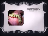 BOI DENTAL IMPLANTS FOR DIABETIC PATIENTS - Copy