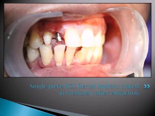 DENTAL IMPLANT AND PERMANENT TEETH IN 4 DAYS