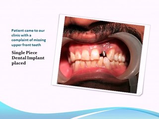 DENTAL IMPLANT FOR UPPER FRONT TEETH
