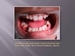 IMMEDIATE DENTAL IMPLANT AFTER EXTRACTION OF MILK TEETH