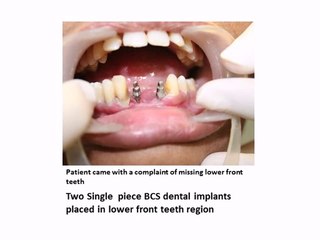 IMMEDIATE LOADING DENTAL IMPLANT IN LOWER FRONT TEETH