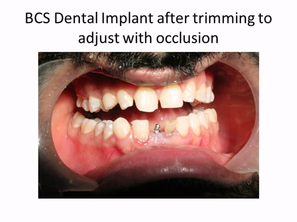 PAINLESS DENTAL IMPLANTS IN INDIA