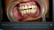REPLACING ACCIDENT MISSING TEETH WITH DENTAL IMPLANTS