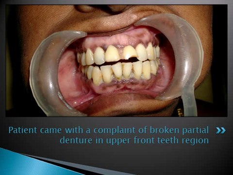 REPLACING ACCIDENT MISSING TEETH WITH DENTAL IMPLANTS