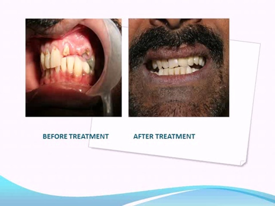smile makeover with dental implants