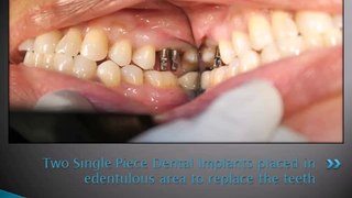 UPPER RIGHT MOLAR TEETH REPLACEMENT WITH DENTAL IMPLANT