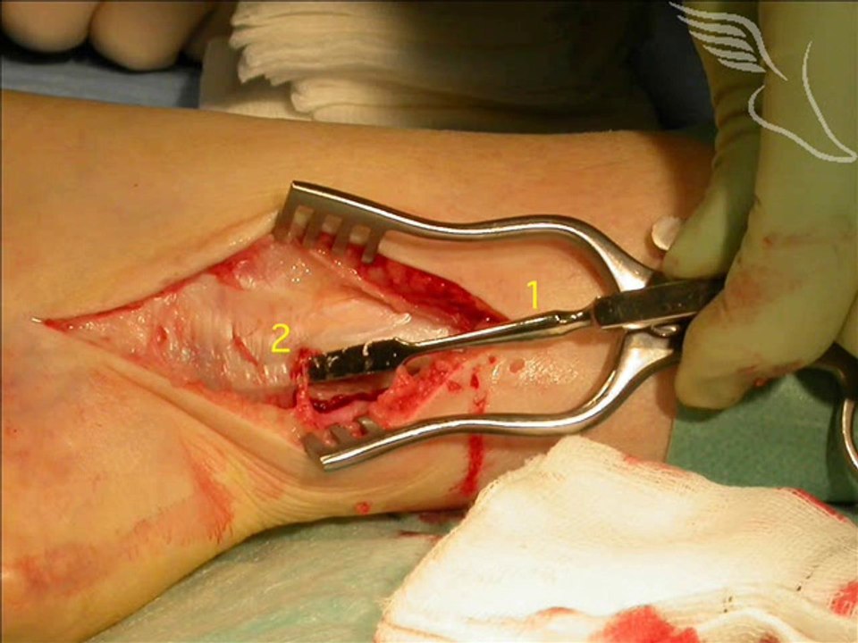 Carpal Tunnel Evaluations