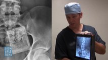 Hilarious Post Colonoscopy Prank.. iPhone and Keys in your Body