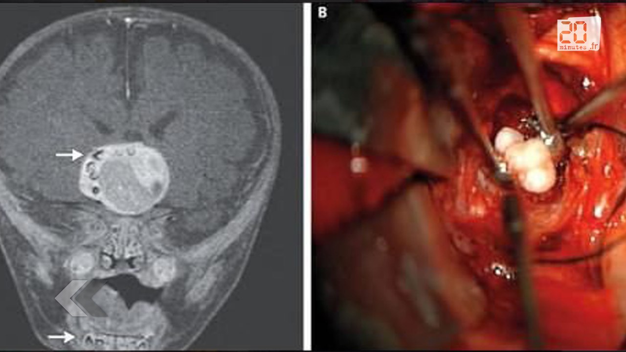 Des dents dans le cerveau d'un bébé de 4 mois