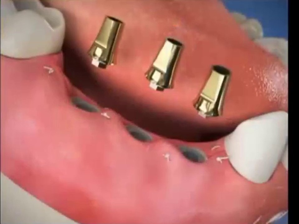 Dental Implant bridges the villages, lady lake, tavares, implant costs, implant dentists mount dora oral surgeon