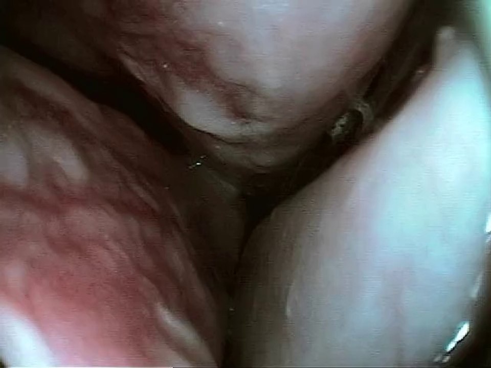 Obstruction des voies respiratoires supérieures