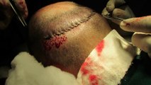 Hair Transplant Procedures in India