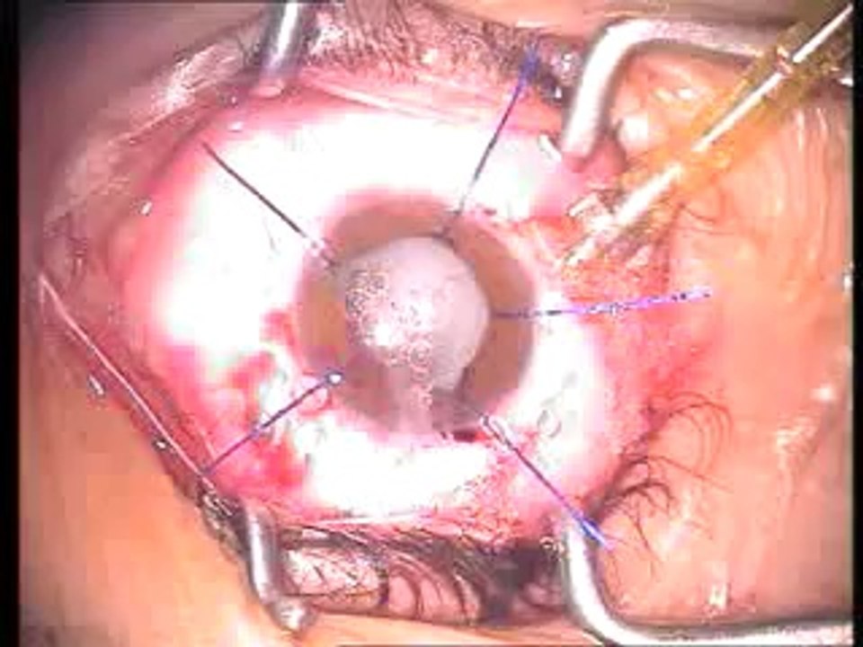 anterior capsulotomy with FUGO Plasma blade