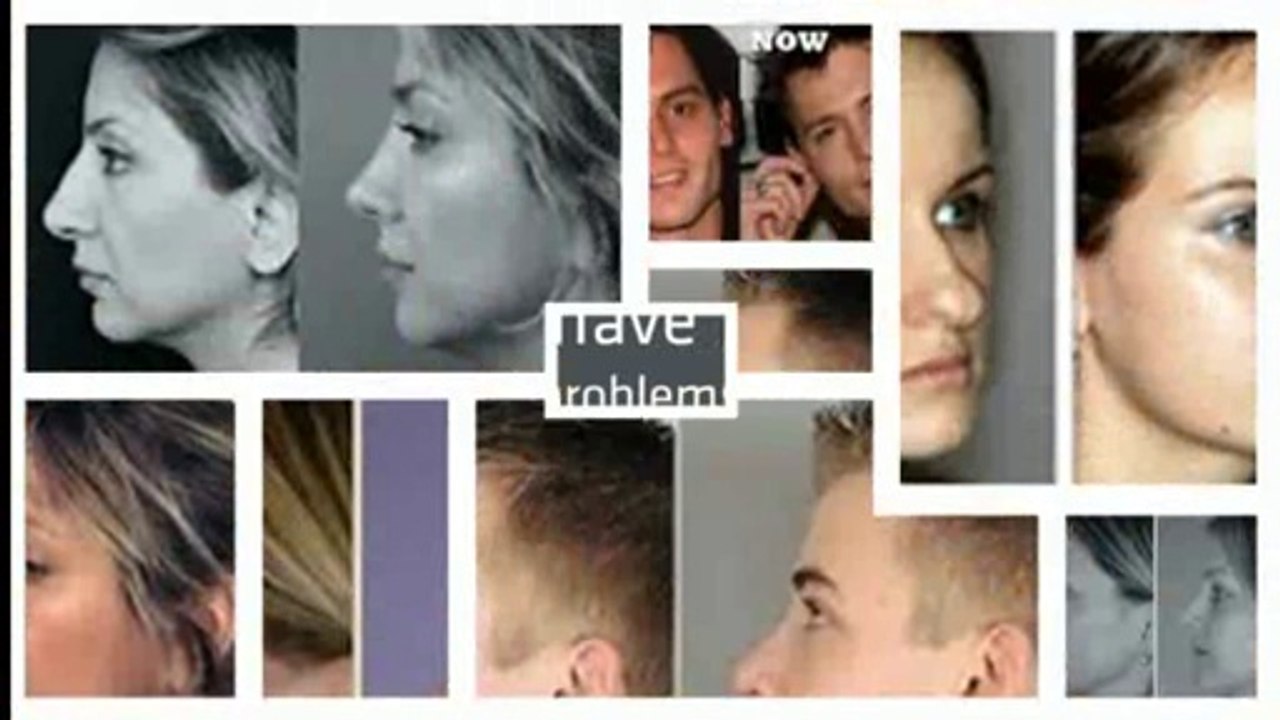 Nose Job Cost