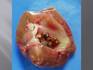 Kidney Stones Treatment