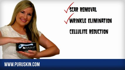 Fine Wrinkles And/Or Stretchmarks? Intro To Finest Microneedle Roller