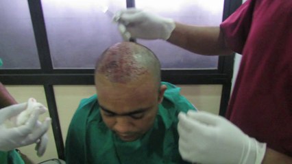 Hair Transplant in Bangalore