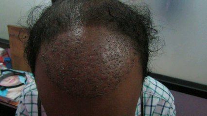 Best Hair Transplant in Bangalore