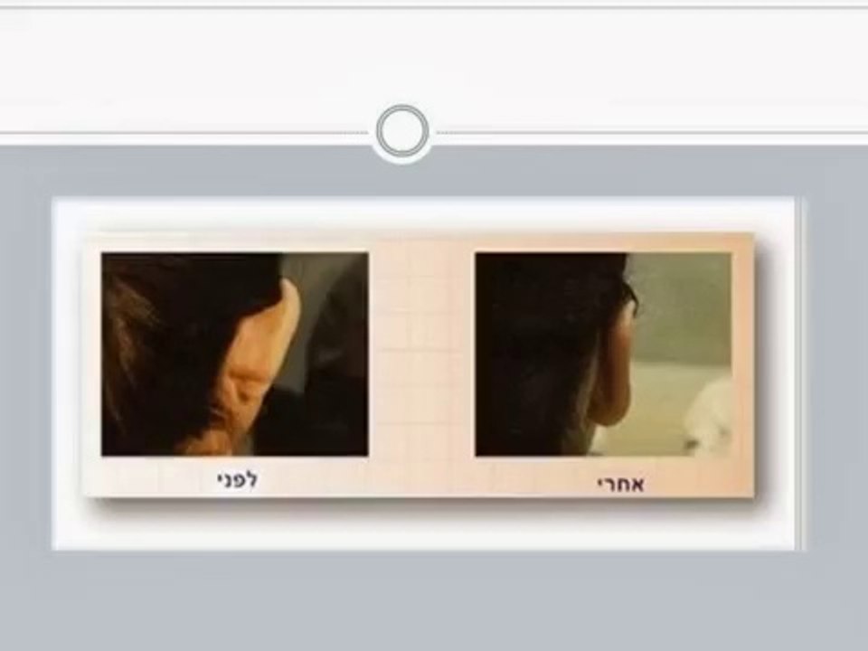 הצמדת אוזניים - הכירו את הטיפול