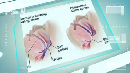 Apnea dental Appliance