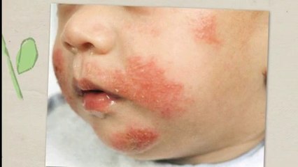 Home Remedies For Eczema
